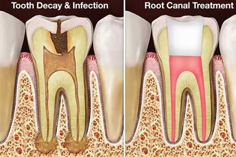 Acacia Dental Group Explains When Root Canal Treatment in Canberra Can Be Recommended
