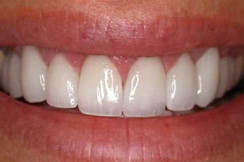 Sydney Holistic Dental Centre Offers Holistic Teeth Whitening
