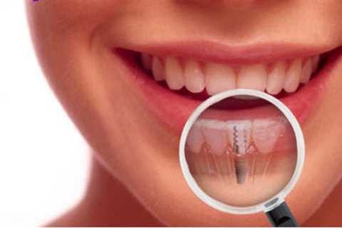 Bexley Dental Explains About Dental Implants Treatment in Sydney