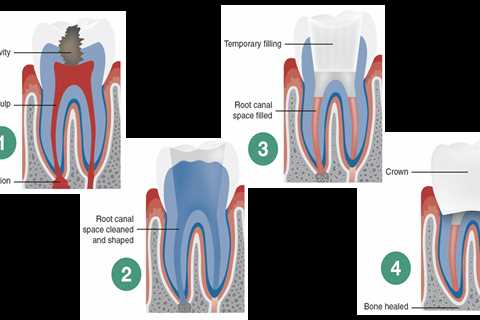 Sydney Holistic Dental Centre’s Holistic Approach to Root Canal Takes the Middle Path Between Two..