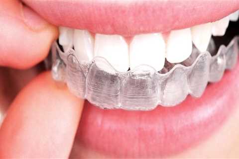 What can be done instead of braces?