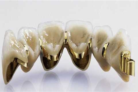 What Types of Dental Supplies are Used to Make Crowns and Bridges?