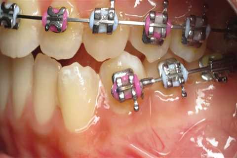 Missing Permanent Teeth: What Are the Special Considerations for Braces with Primary and Permanent..
