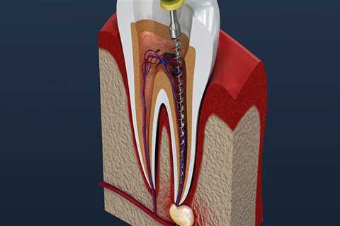 The Importance Of Root Canal For Bicuspids And How Austin Dentists Can Help