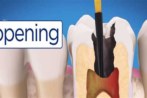 Root Canals in Primary and Permanent Bicuspids: Special Considerations