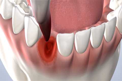 Post-Operative Care Instructions After Dental Surgery