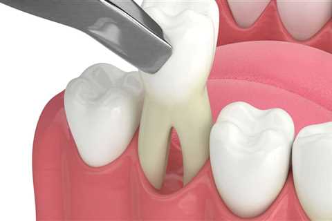 What Activities Should You Avoid After Oral Surgery?
