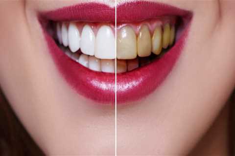 How Often Should You Whiten Your Teeth? Expert Advice on Teeth Brightening