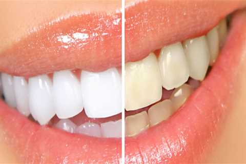 Maintaining a Bright Smile After Professional Teeth Whitening: Tips and Tricks