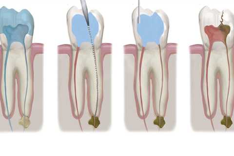 Can I Smoke After My Endodontic Appointment?