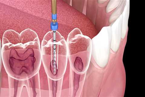 What is Root Canal Therapy and How Can it Save Your Teeth?