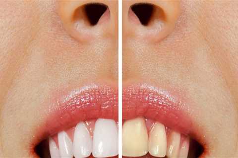 The Best Over-the-Counter Teeth Whitening Solutions: A Comprehensive Guide