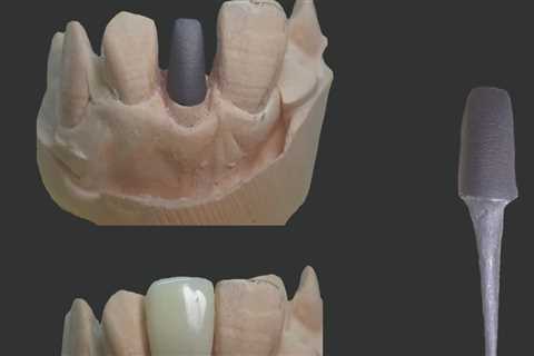 What is a Post and Core Restoration Procedure?