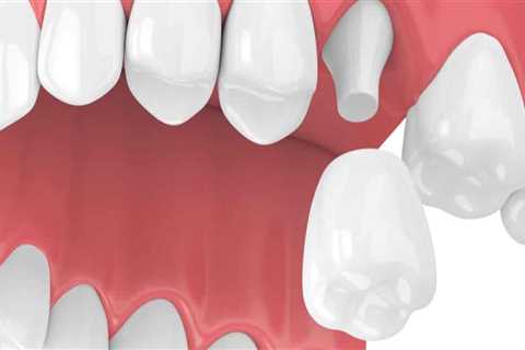 Everything You Need to Know About Dental Crowns