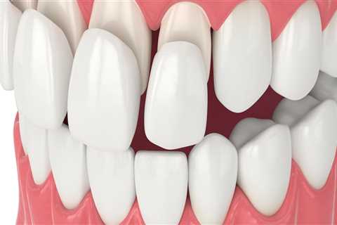 The Best Dental Assistants In Spring, TX Who Can Assist With Porcelain Veneers