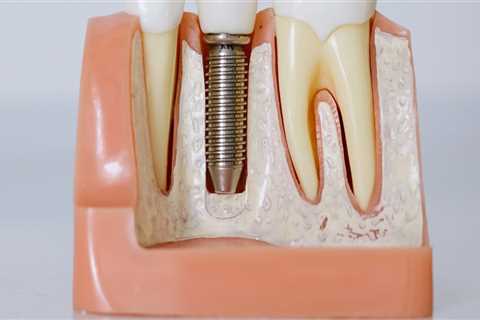 Revitalize Your Smile With Restorative Dentistry Implants In Austin, TX: Bicuspid Edition