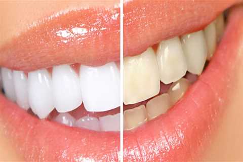 Cosmetic Dentistry In Waco: Enhancing Your Smile With Teeth Whitening