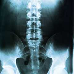 June 22 2023 - GE HealthCare partners with J&J to push spine imaging system