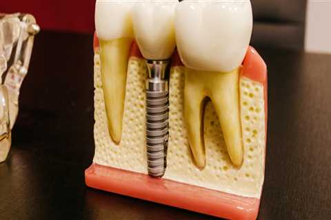 Georgetown's Dental Revolution: The Harmony Of Dental Implants And Endodontics