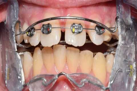 How Braces In Commerce City, CO, Can Benefit From The Common Dental Supplies