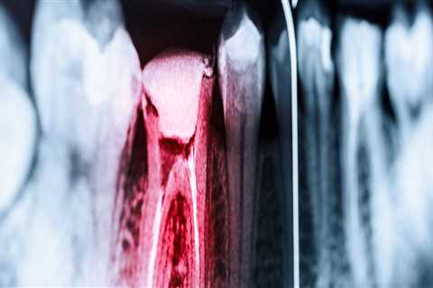 Root Canal Treatment in Nashville, TN: What You Need to Know