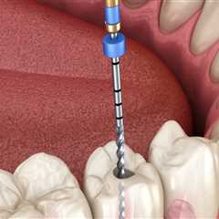 Which Type of Dentist is Best for Root Canal Treatment?