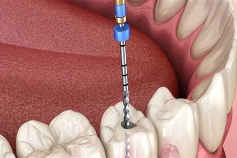 Which Type of Dentist is Best for Root Canal Treatment?