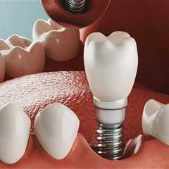 How Much Does it Cost to Get Dental Implants in Orange County, CA?