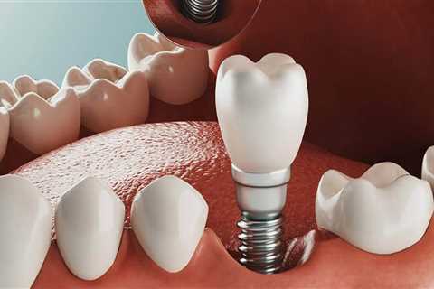 How Much Does it Cost to Get Dental Implants in Orange County, CA?