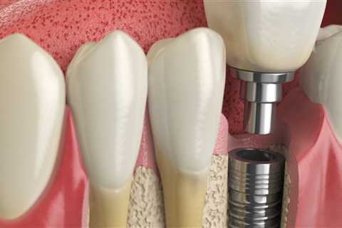 The Road To A New Smile: Periodontics Leading To Dental Implants In Cedar Park, TX