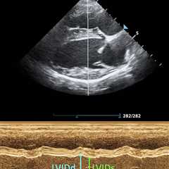 Objective Assessment of Left Ventricular Systolic Function on Focused Cardiac Ultrasound with Dr...