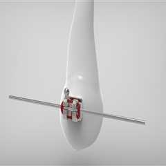 Understanding Bicuspids and Their Role in Dental Health