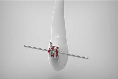 Understanding Bicuspids and Their Role in Dental Health