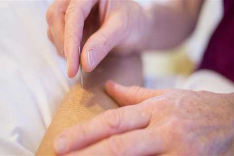 Reduce Stress with Acupuncture for Feet in Portland