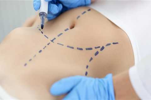 Exploring Functional Medicine and Liposuction Costs in AZ